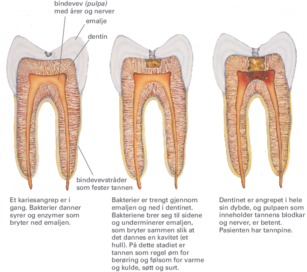 Karies, forklart