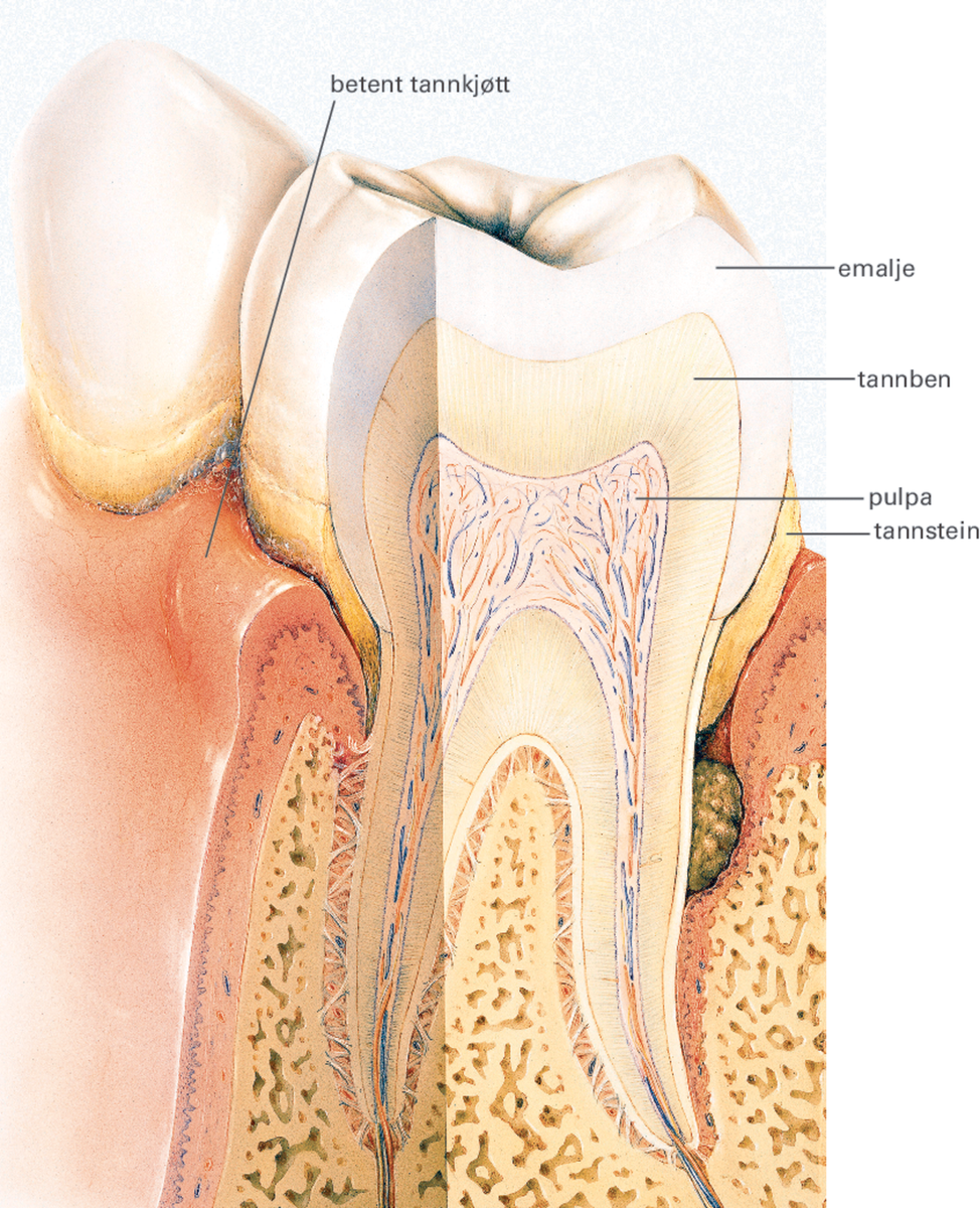 Periodontitt