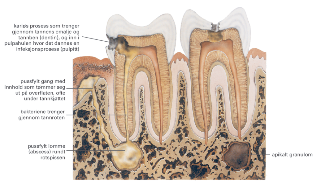 Illustrasjon av tannrotbetennelse