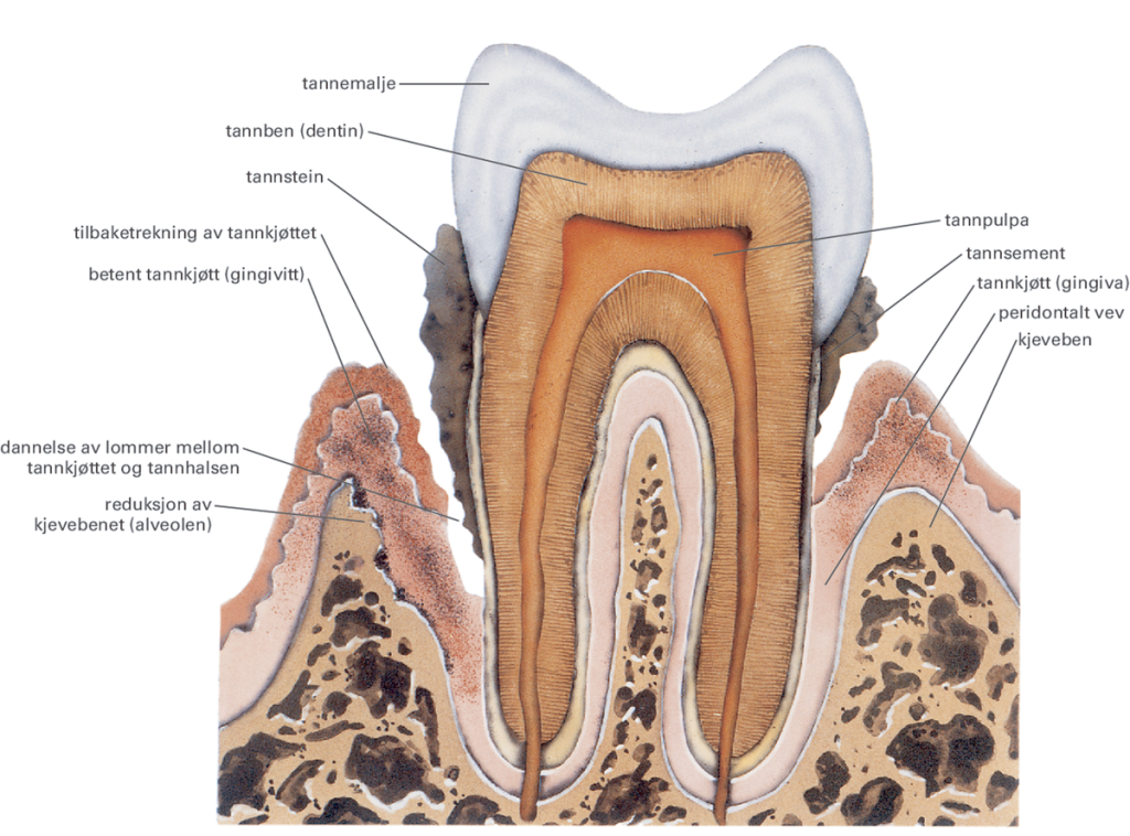 Illustrasjon av tannstein